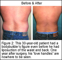 30 year old liposuction patient