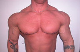 male breast reduction before & after