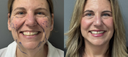 Facelift