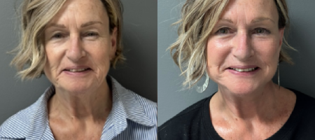 Neck Lift
