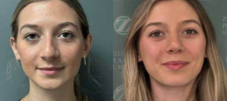 Nose Surgery