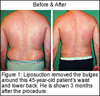 45 year old liposuction patient
