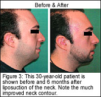 30 year old neck liposuction patient