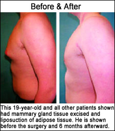 19 year old gynecomastia patient