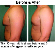 30 year old gynecomastia patient