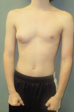 Dr. Blau's patient results for gynecomastia/breast reduction in New York City