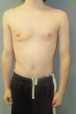 Dr. Blau's patient results for gynecomastia/breast reduction in New York City