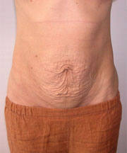 abdominoplasty before & after