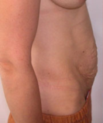 Abdominoplasty