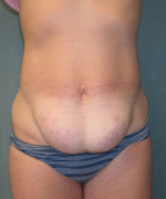 Abdominoplasty