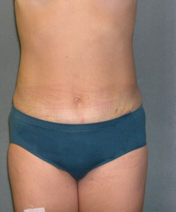 Abdominoplasty After Photo Abdominoplasty