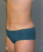 Abdominoplasty