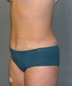 Abdominoplasty