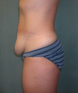 Abdominoplasty