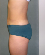 Abdominoplasty