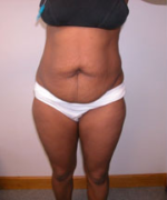 Abdominoplasty