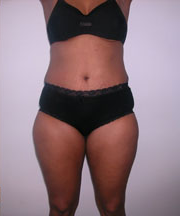 Abdominoplasty