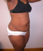 Abdominoplasty