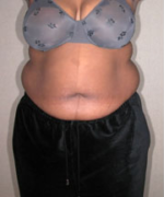 Abdominoplasty