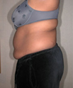 Abdominoplasty