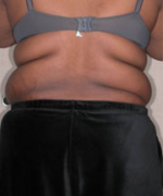 Abdominoplasty