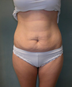 Abdominoplasty