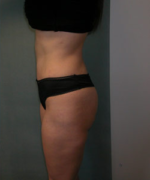 Abdominoplasty