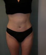 Abdominoplasty