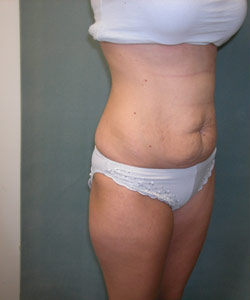 Abdominoplasty