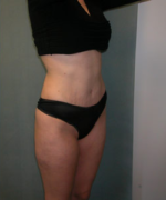 Abdominoplasty