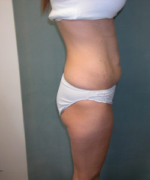 Abdominoplasty