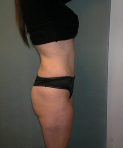 Abdominoplasty