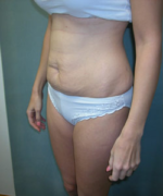 Abdominoplasty