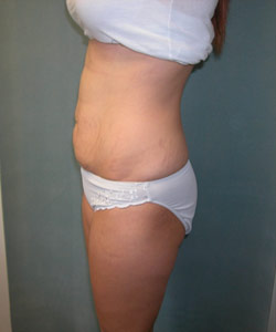 Abdominoplasty