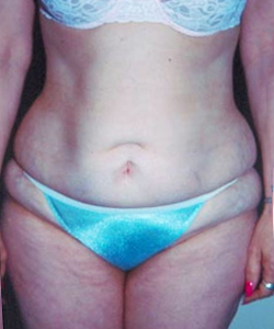 Abdominoplasty