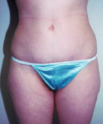 Abdominoplasty