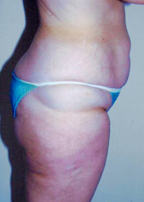 Abdominoplasty