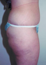 Abdominoplasty