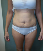 Abdominoplasty