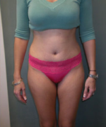 Abdominoplasty