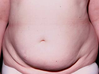 Abdominoplasty Before Photo Abdominoplasty