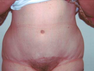 Abdominoplasty After Photo Abdominoplasty