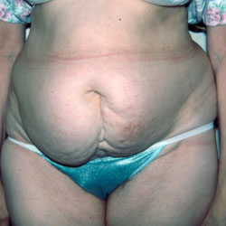 Abdominoplasty