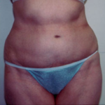 Abdominoplasty