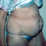 Abdominoplasty