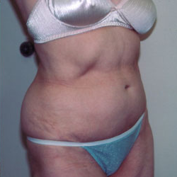 Abdominoplasty