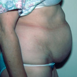 Abdominoplasty