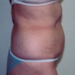 Abdominoplasty