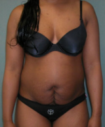 Abdominoplasty