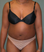 Abdominoplasty